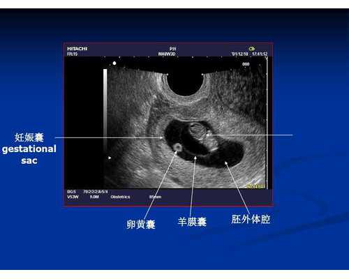 广州试管婴儿一代,广州三代试管的医院